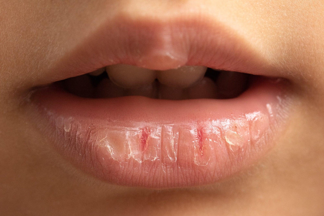 Naturally Pink Lips in Winter? The Right Lip Balm Makes All the Difference